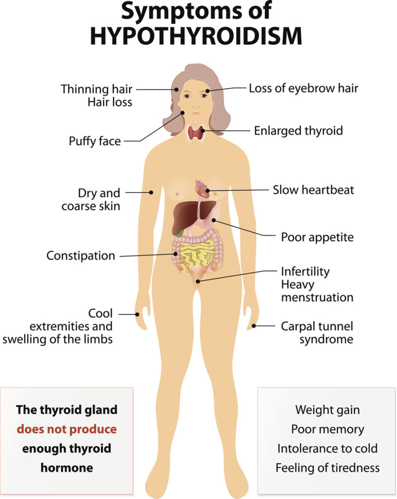 image-hypothyroidism symptoms