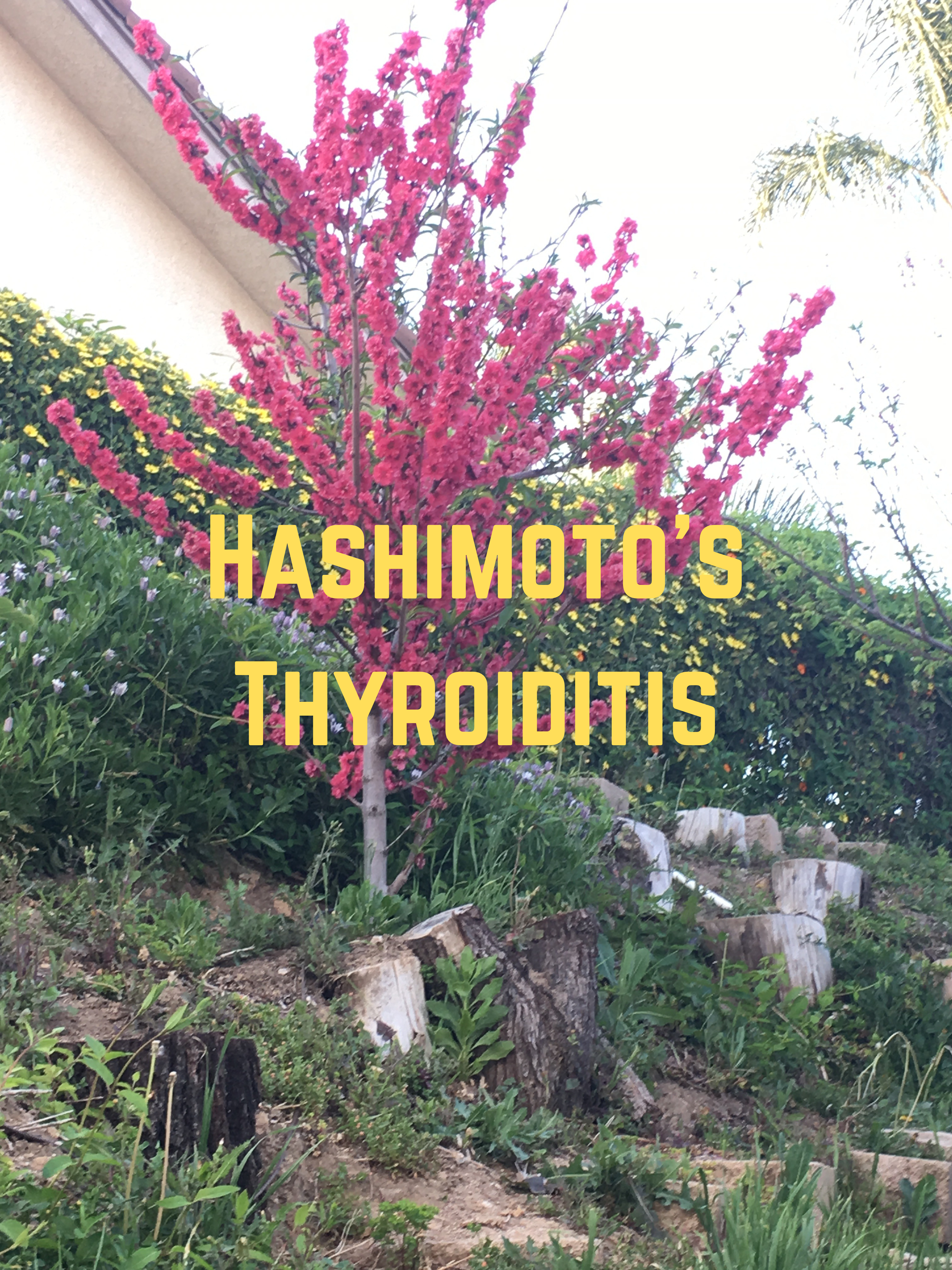 Hashimoto's Thyroiditis , myths, diagnosis, treatment
